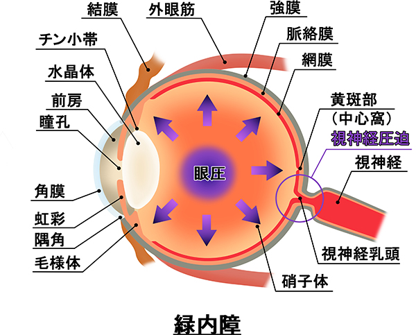 緑内障のイメージ図