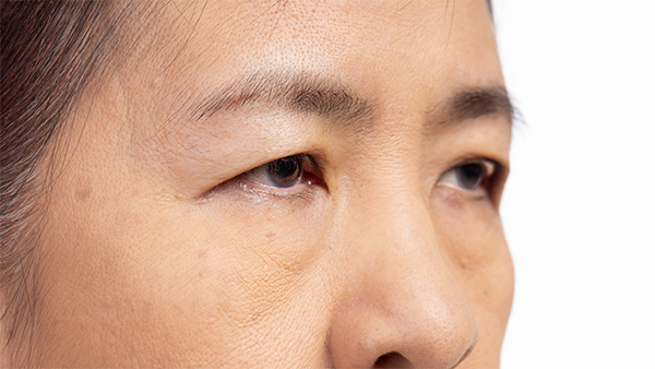 眼瞼下垂のイメージ